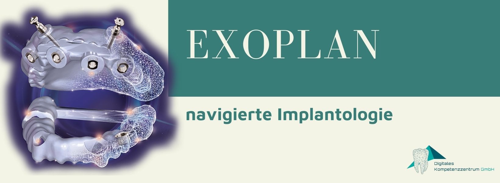 exoplan – navigierte Implantologie